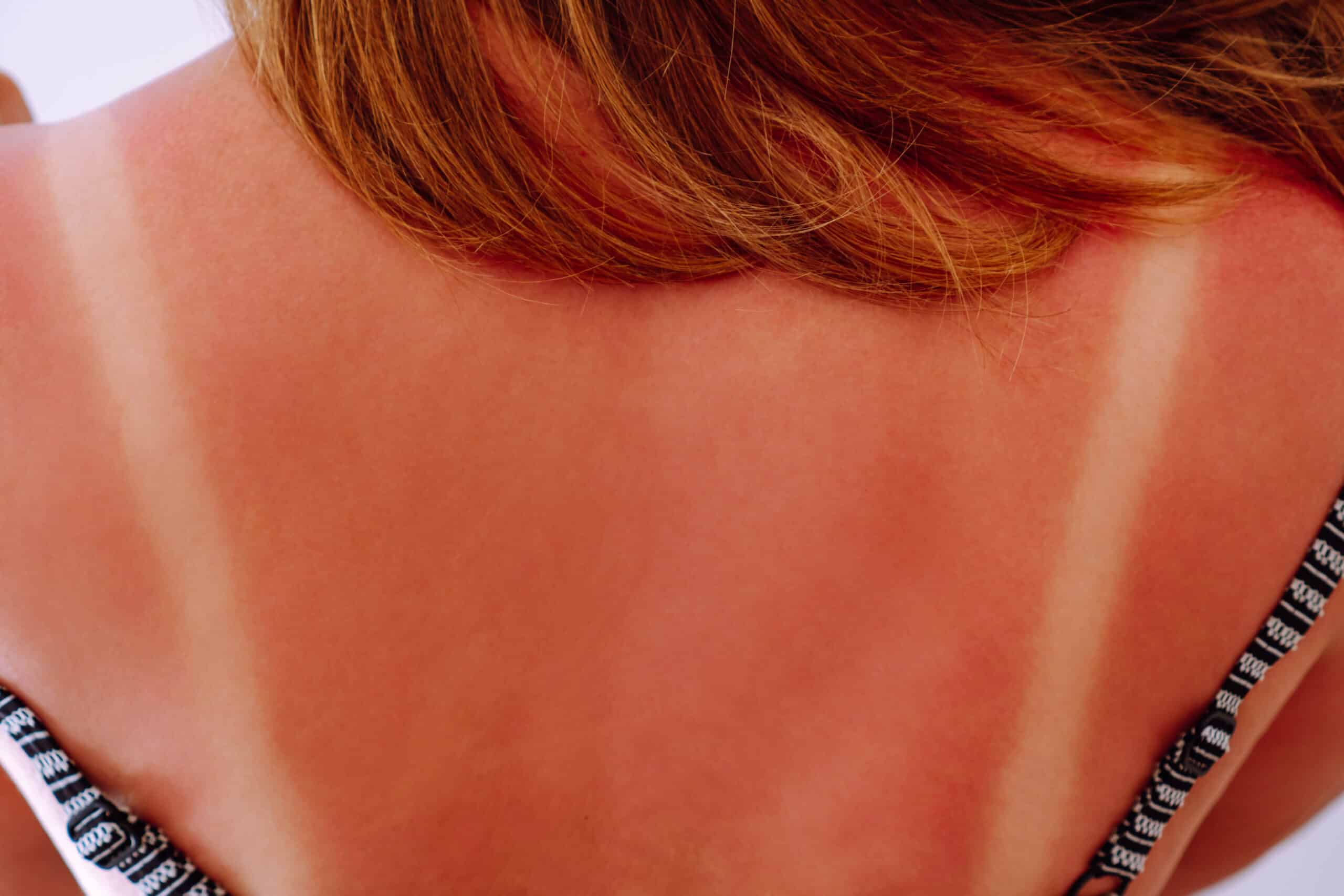 Radiation burn first aid - Back view of young woman with light traces of swimsuit on sunburnt naked back on blue background. Summer, UV protection, health, cosmetology, dermatology, sunbathing, sun block, tanning, skincare.